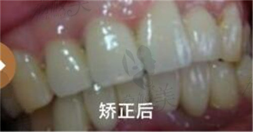 上海谷提斯口腔牙齿矫正后