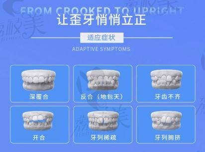 牙齿矫正要趁早