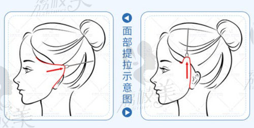 面部提升提拉