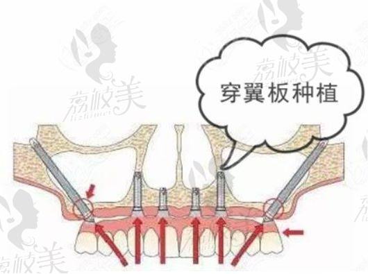 穿颧穿翼种植牙