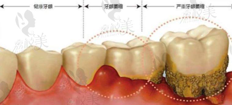 牙龈萎缩示意图