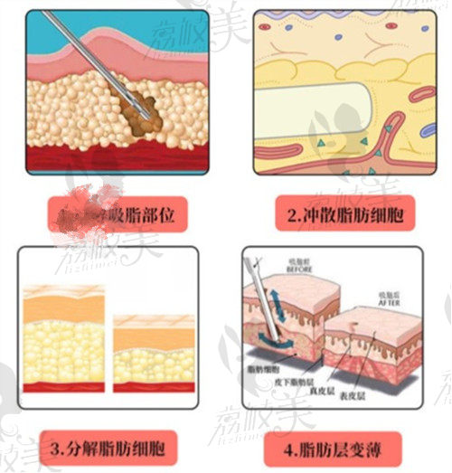 郑州缔莱美董斌医生做面部吸脂