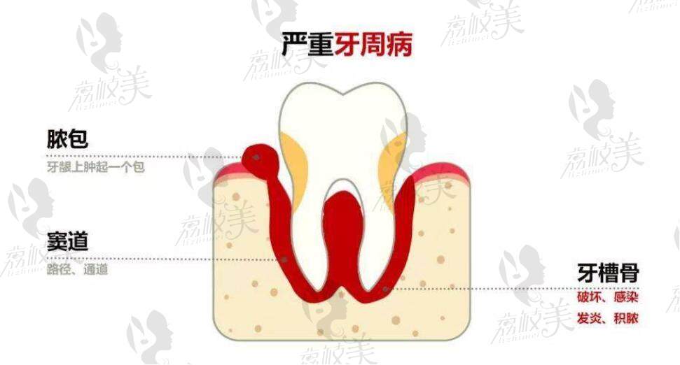 牙槽骨吸收不足