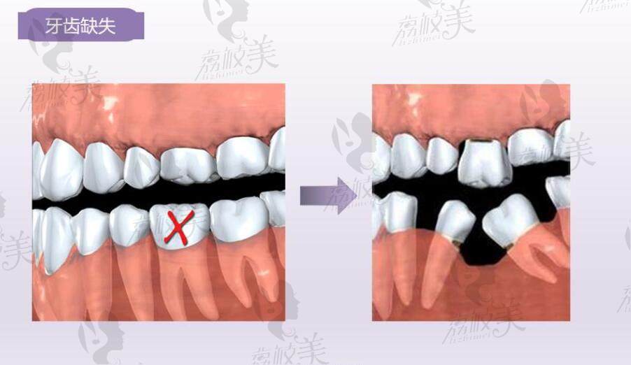 牙齿缺失导致临牙倾斜