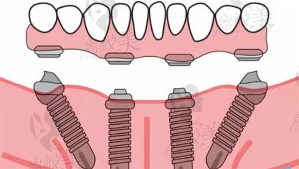 ALL-ON-4种植牙