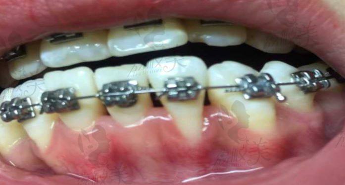 牙龈萎缩进行牙齿矫正