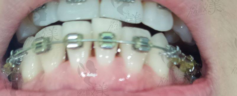牙龈萎缩进行牙齿矫正