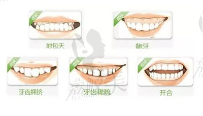 牙齒畸形.jpg?x-oss-process=style/lzmei 牙齒畸形.jpg
