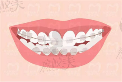 牙齒矯正手術(shù).jpg?x-oss-process=style/lzmei 牙齒矯正手術(shù).jpg
