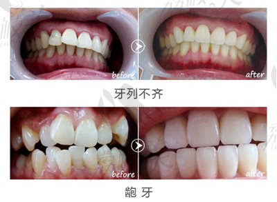 牙齒不整齊.jpg?x-oss-process=style/lzmei 牙齒不整齊.jpg