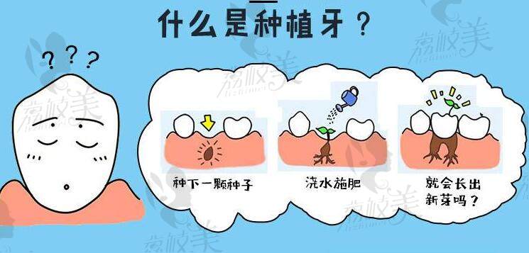 种植牙原理介绍