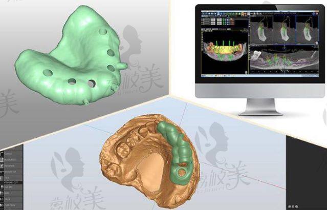 3D数字化导板种植