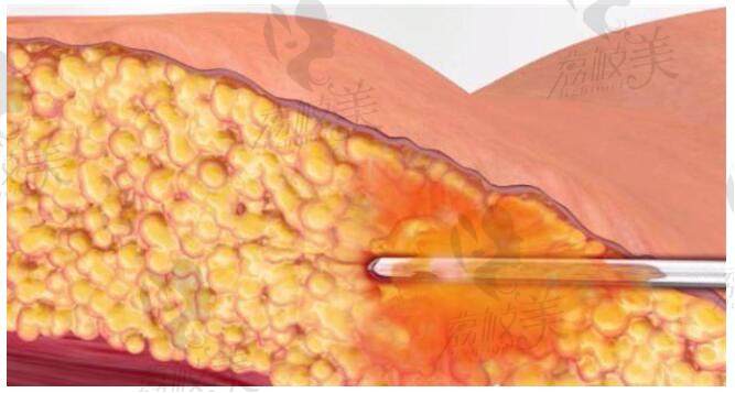 吸脂的原理