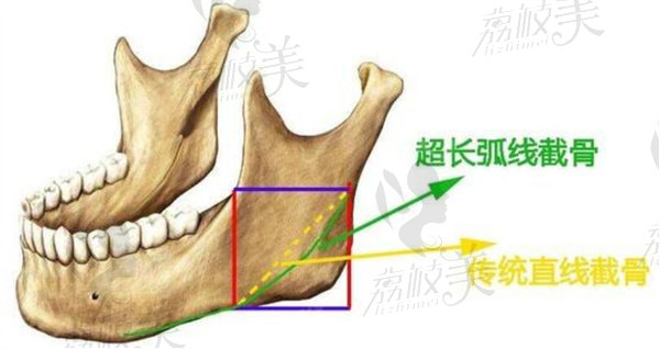 超长弧线颧骨