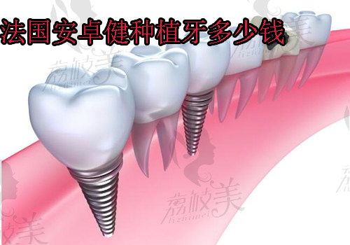 法国安卓健种植牙多少钱