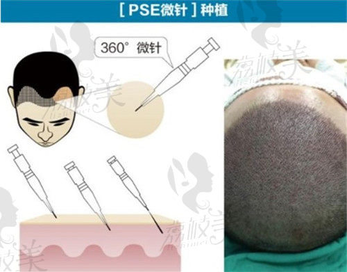 微针植发技术