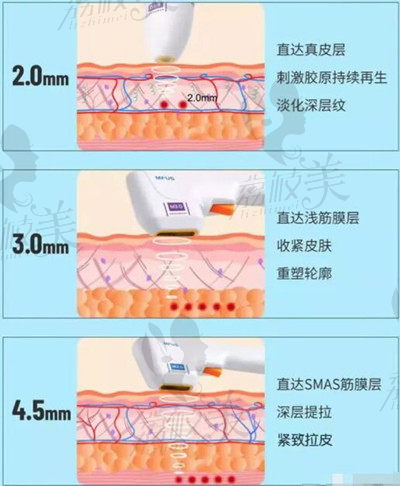 半島超聲炮的三種治療深度