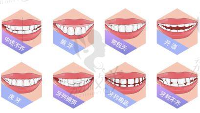 牙列不齐示意图