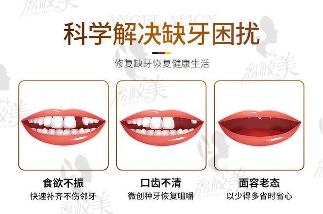 广州柏德口腔科学解决缺牙困扰