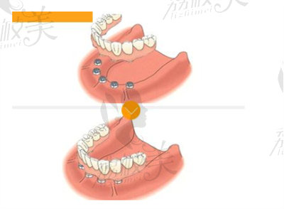all-on-4/6種植技術(shù)的優(yōu)勢(shì)2.jpg