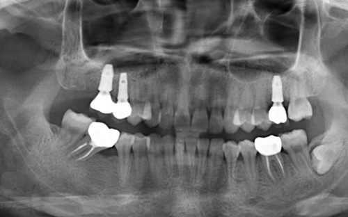 徐州美奥口腔做多颗种植牙术后牙片