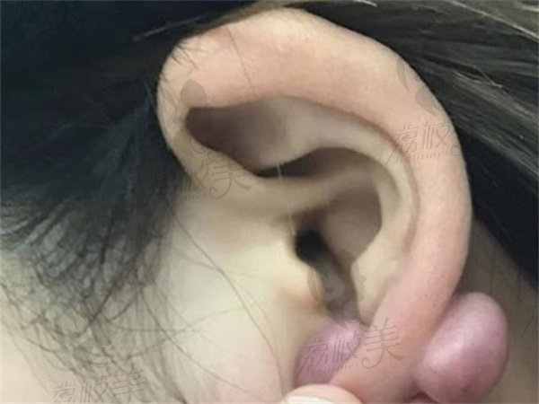 疤痕体质耳朵上长疙瘩做手术需要多少钱？看这些治疗方案适合自己吗