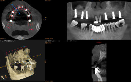東莞同步齒科種植牙CT