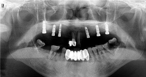 東莞同步齒科種植牙后的CT圖