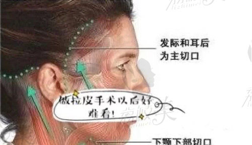 拉皮手术的切口选择
