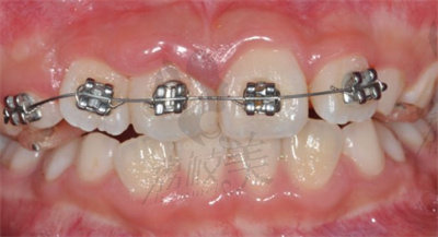 金屬托槽矯正手術(shù)的步驟.jpg