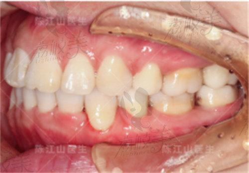 陈江山骨性矫正后牙弓回归
