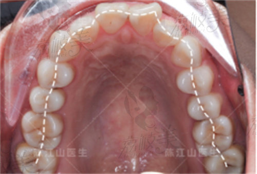 陈江山骨性矫正前牙弓不流畅