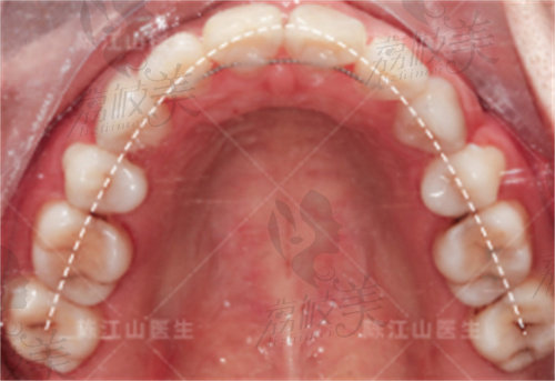 陈江山骨性矫正后牙弓流畅自然