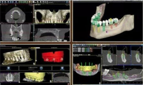 深圳正夫口腔数字化种植牙