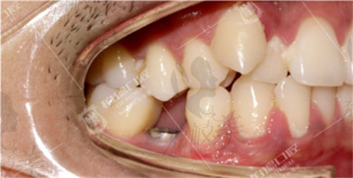 廣州柏德口腔種植牙側(cè)面