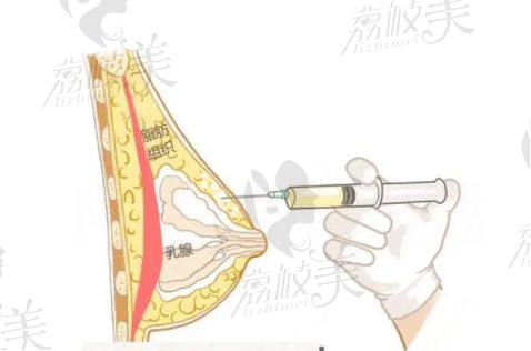 北京京美整形脂肪隆胸