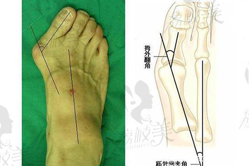 大腳骨外翻