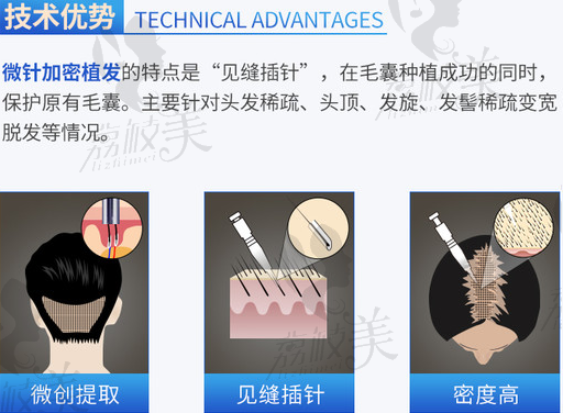 北京大麥微針植發(fā)技術(shù)優(yōu)勢(shì)