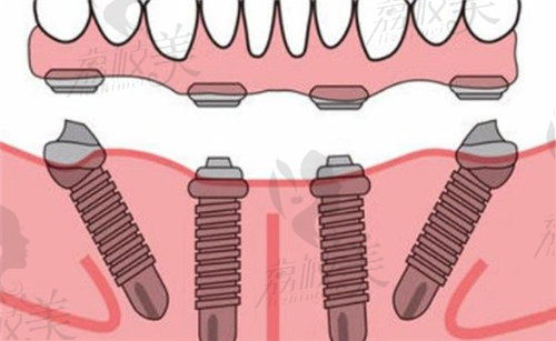 牙管家口腔种植牙技术优势