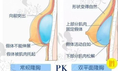 美莱胸部整形技术优势