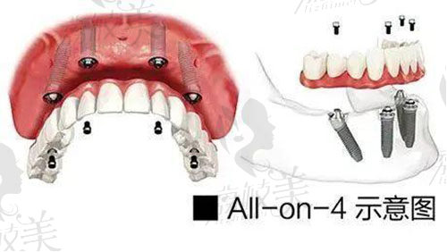 all on 4种植牙收费，种植牙收费标准2022年版