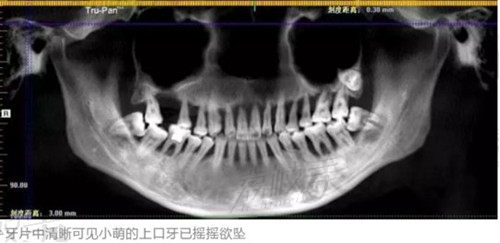 28岁姑娘患上牙周炎需要拔掉整个上半口牙