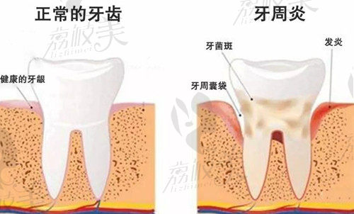 正常牙齿和患有牙周炎的牙齿区别