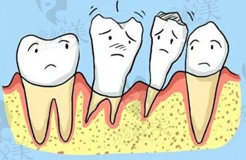 牙周炎导致牙齿出现松动