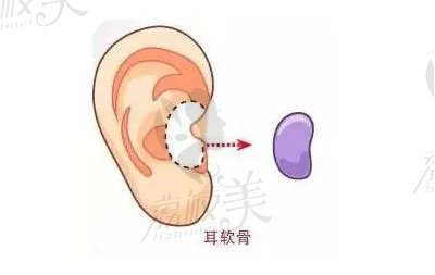双侧耳软骨鼻综合技术.jpg