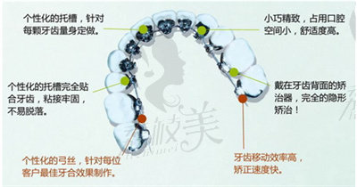 秦龍院長做舌側(cè)矯正的技術(shù)優(yōu)勢.jpg