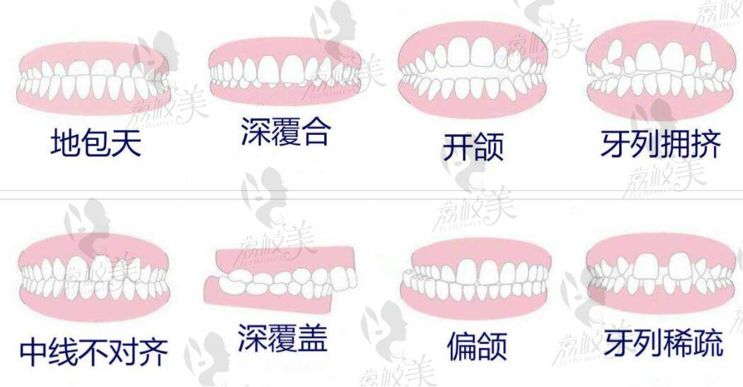 各类错颌畸形的牙齿类型