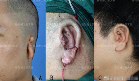 廣州高尚余文林耳再造病例