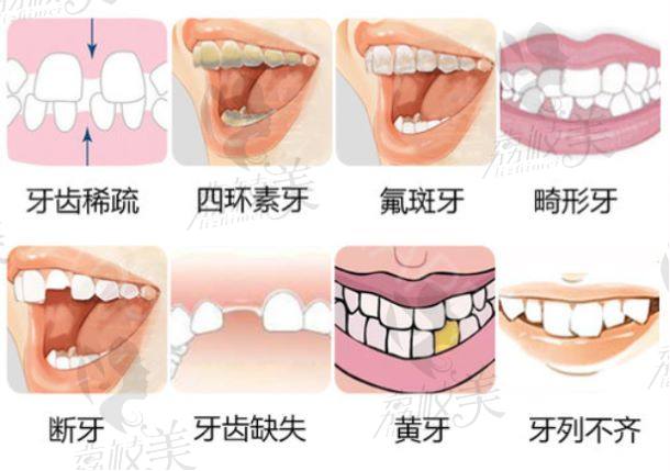 什么样的牙适合做贴面