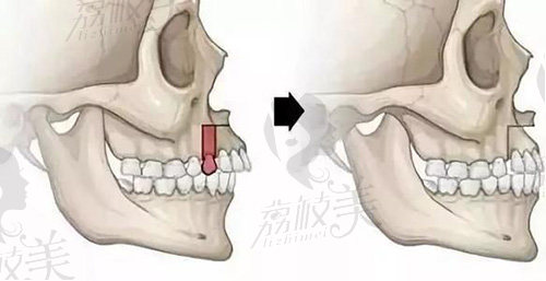 骨性龅牙